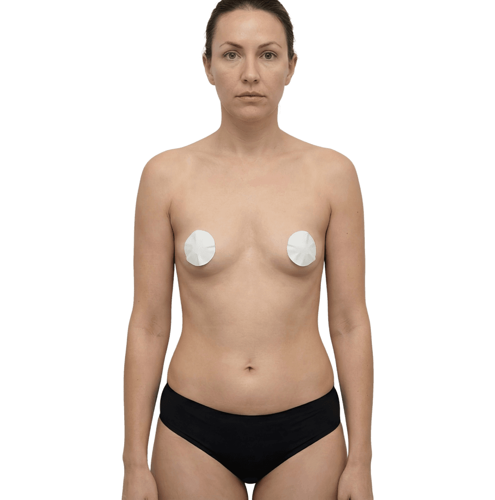 Breast Augmentation before