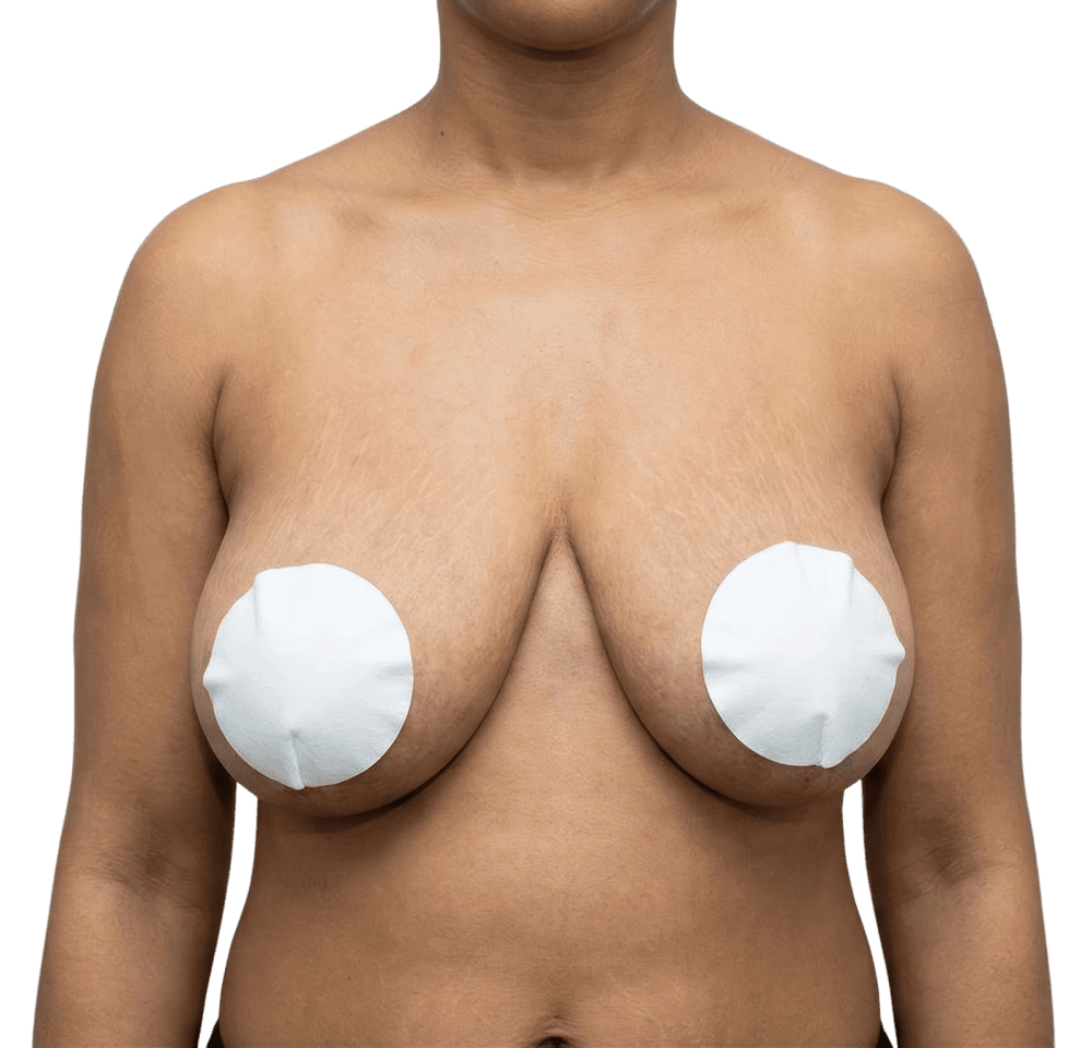 Breast Reduction before