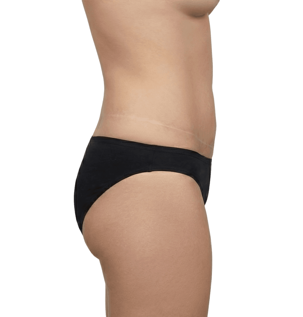 Tummy Tuck after