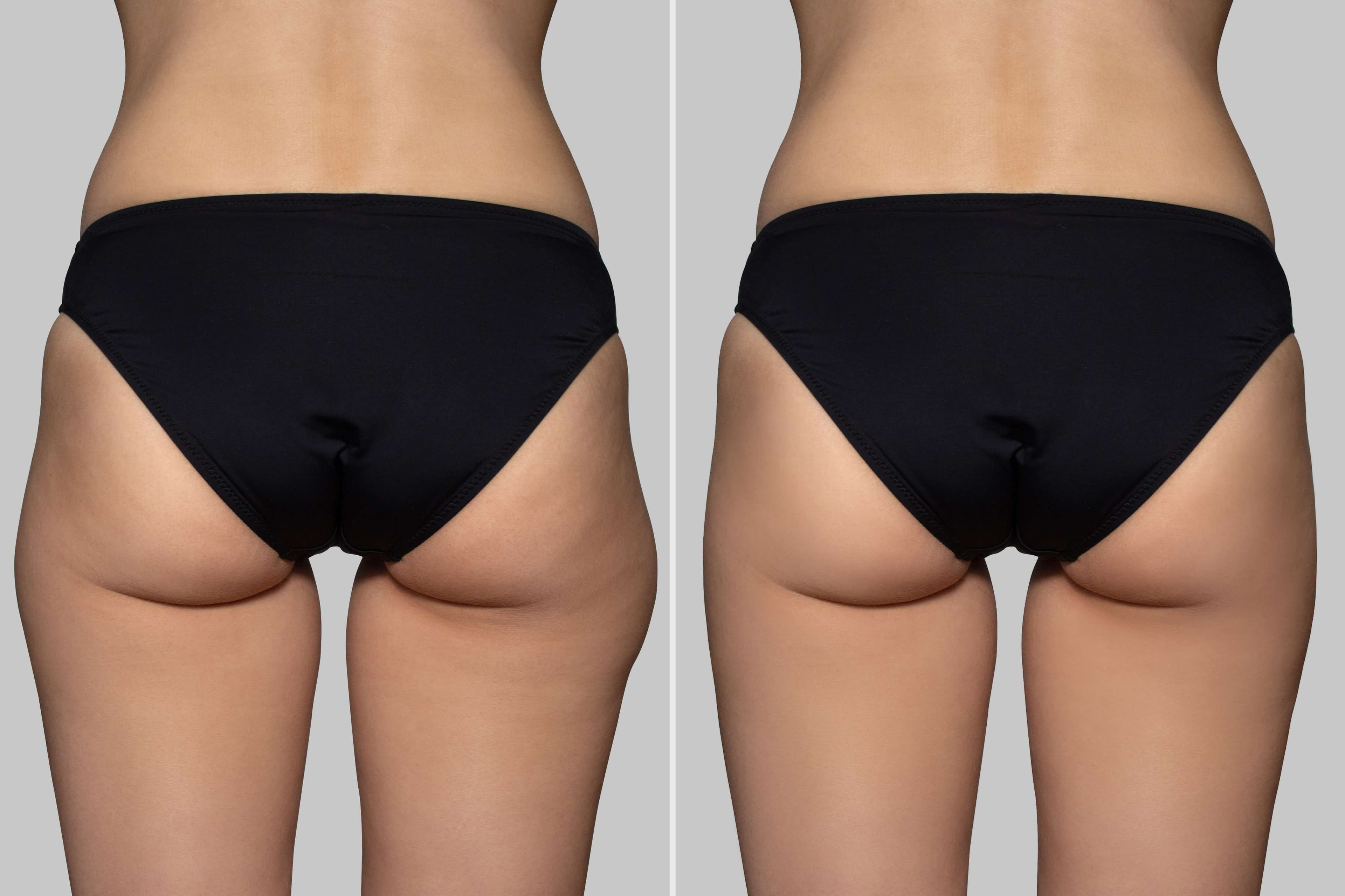 Before and after procedure result