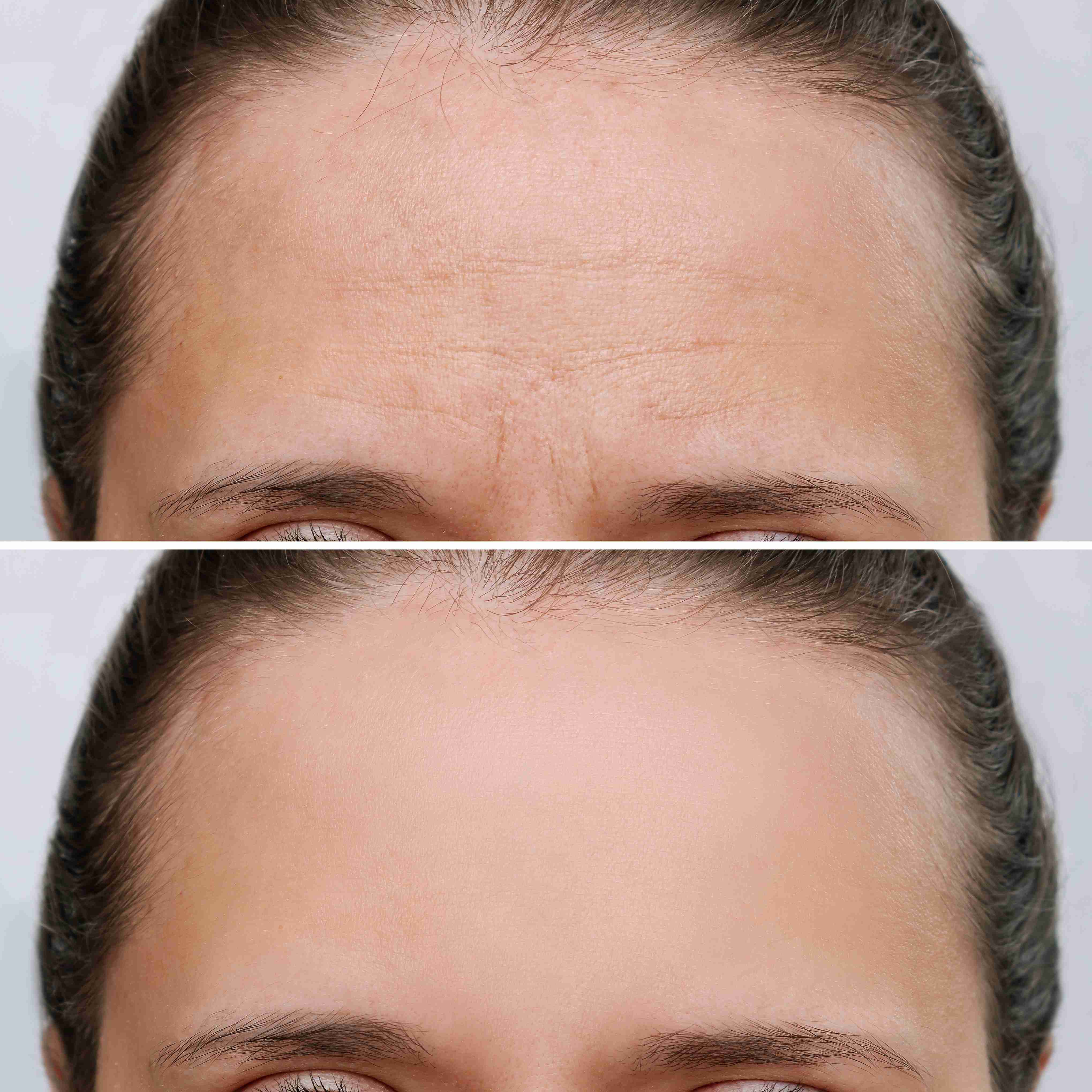 Before and after procedure result