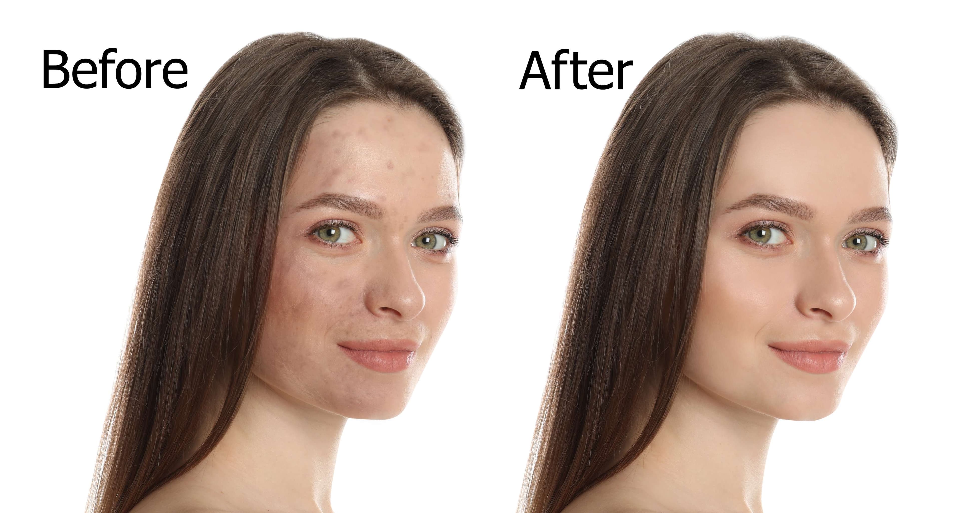 Before and after procedure result