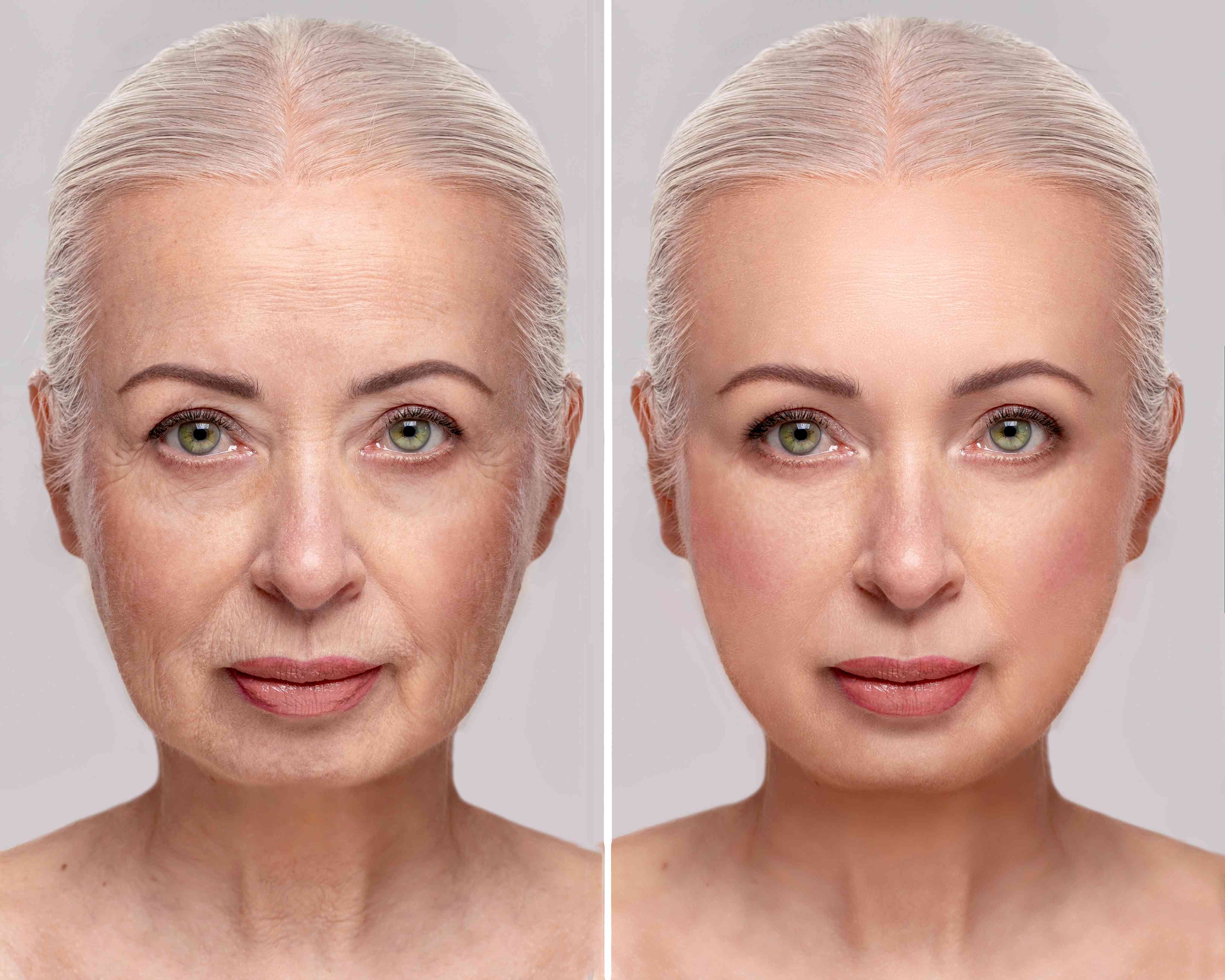 Before and after procedure result