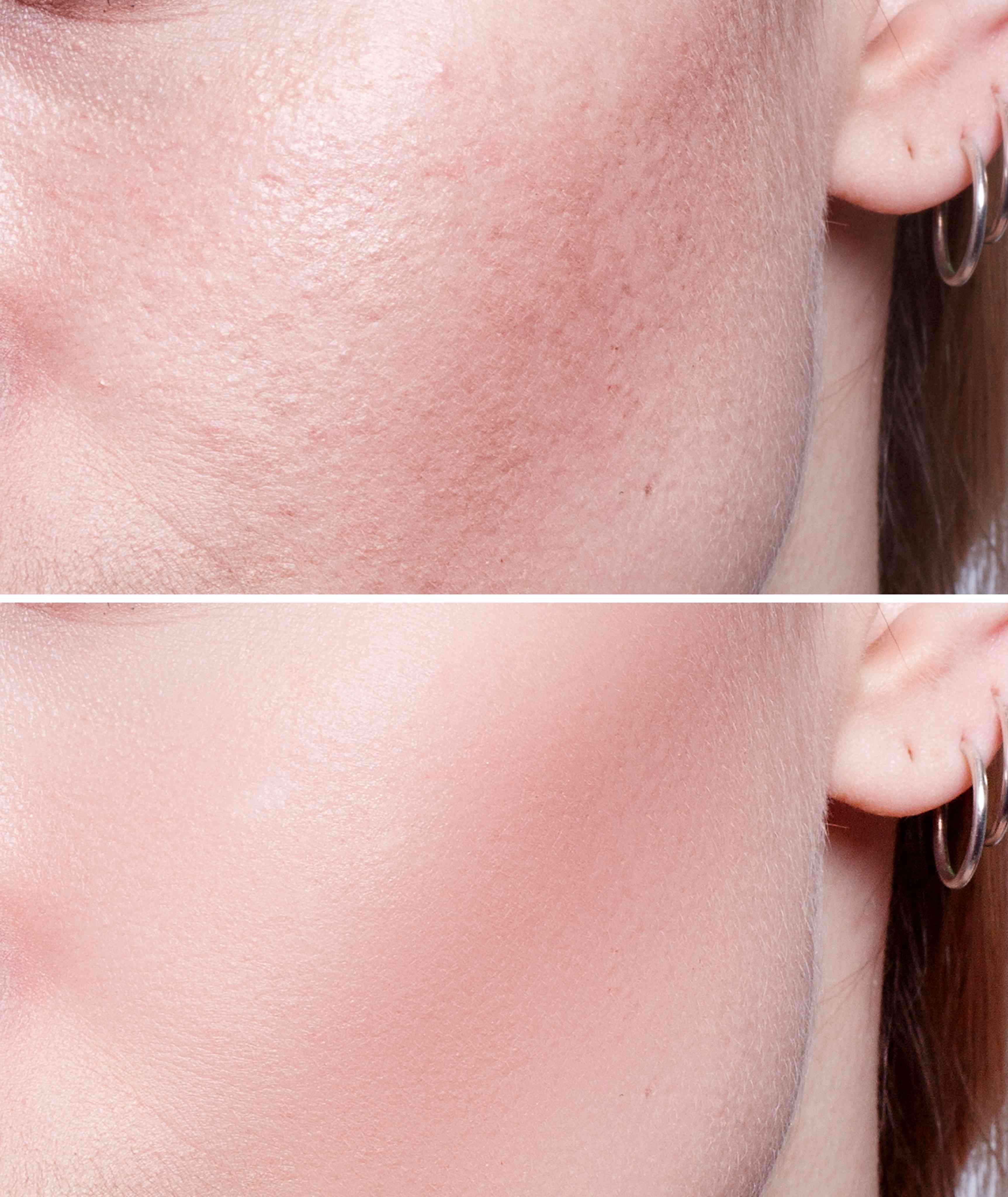 Before and after procedure result