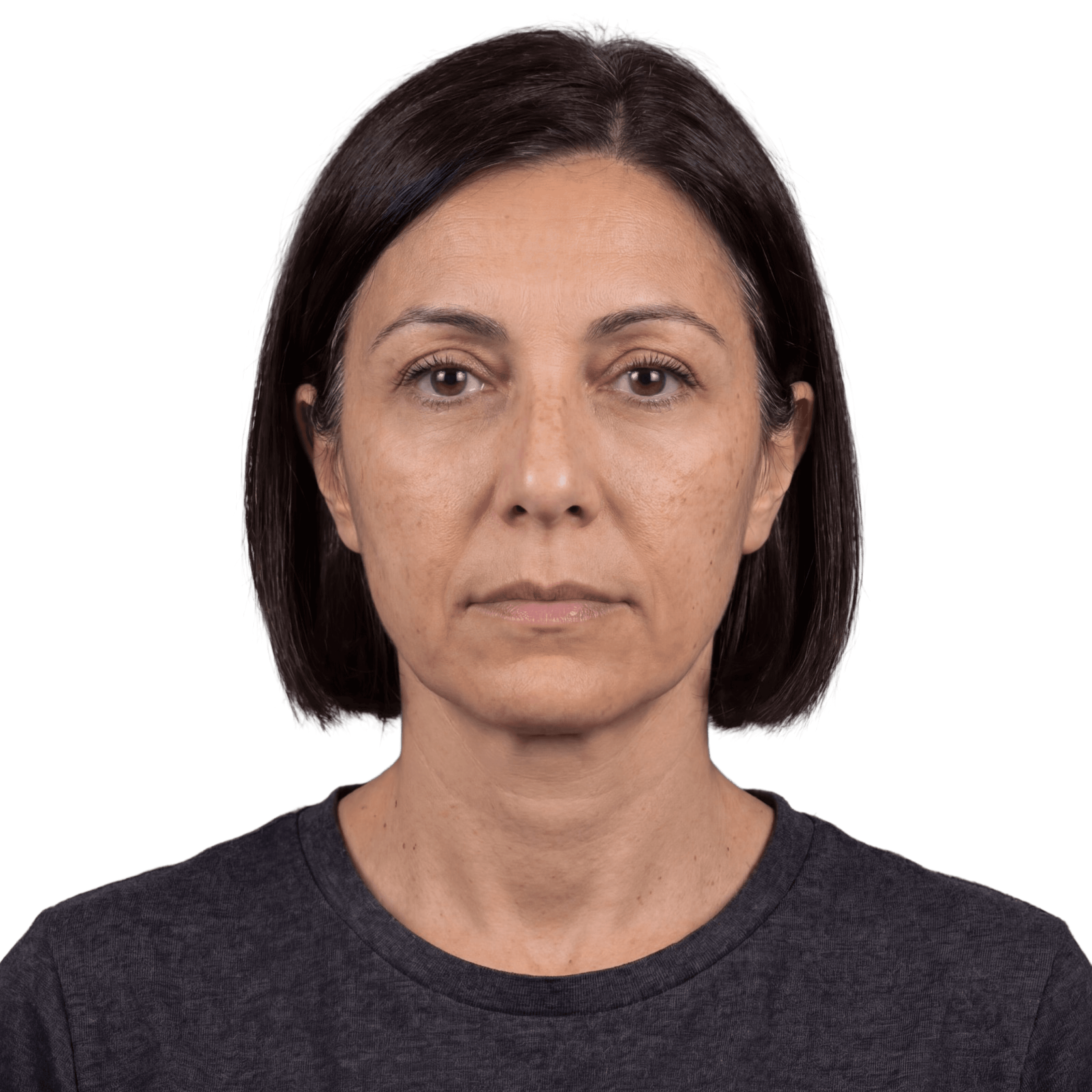 Blepharoplasty after