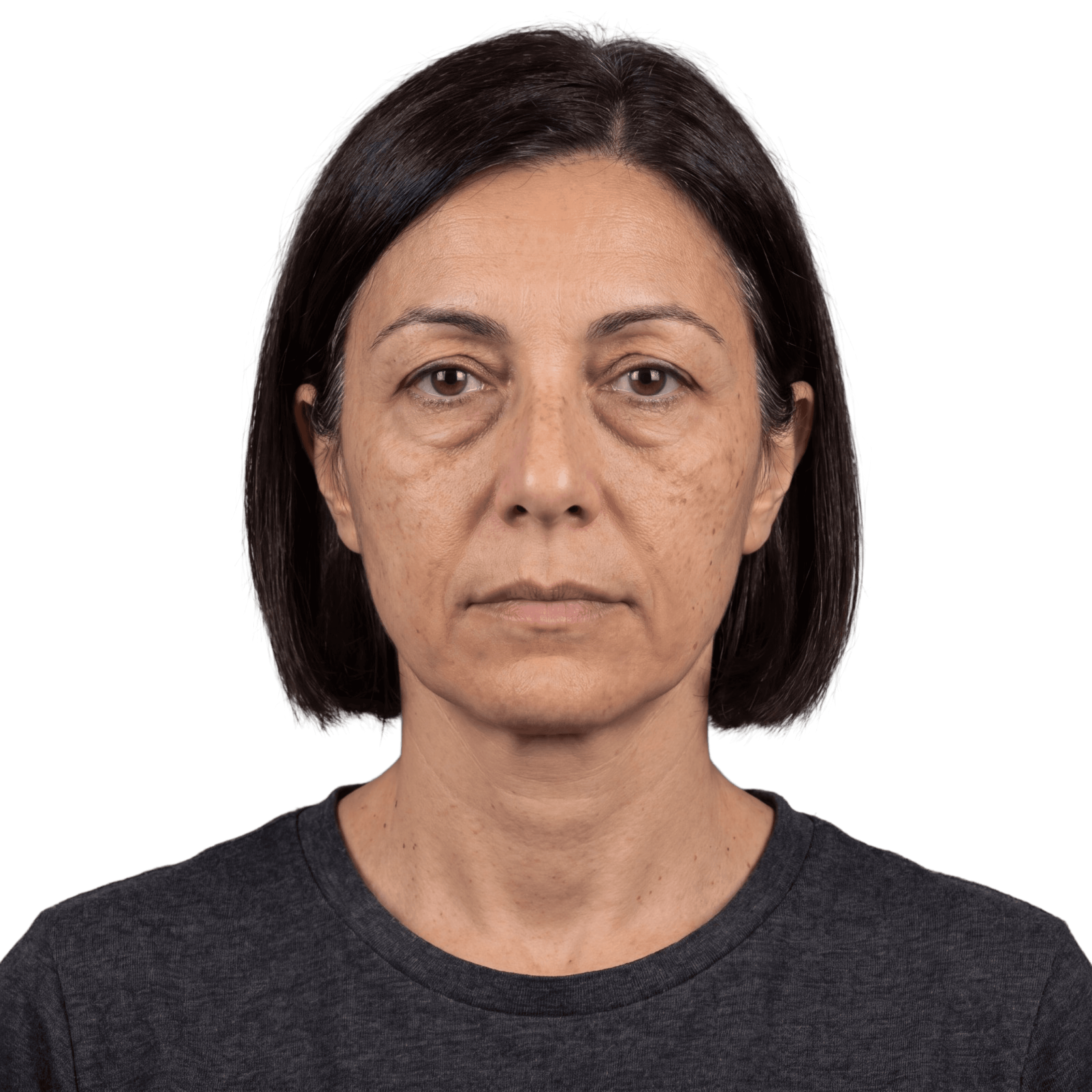 Blepharoplasty before