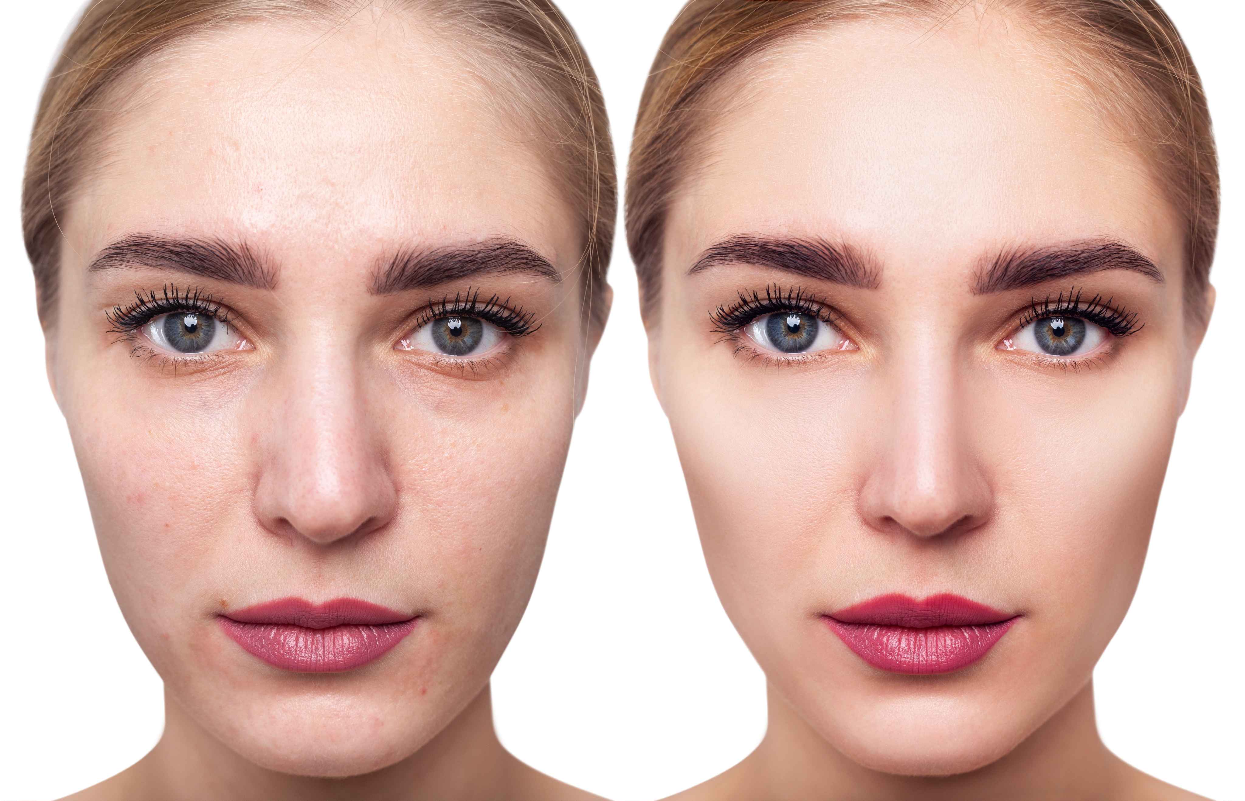 Before and after procedure result