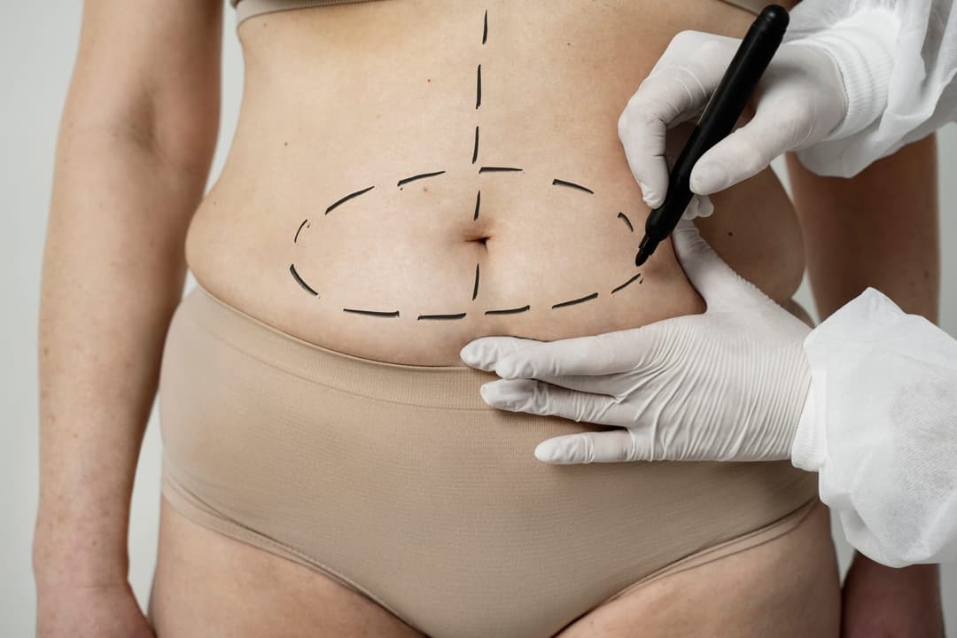 Tummy Tuck Recovery Tips in Austin: Week-by-Week Guide