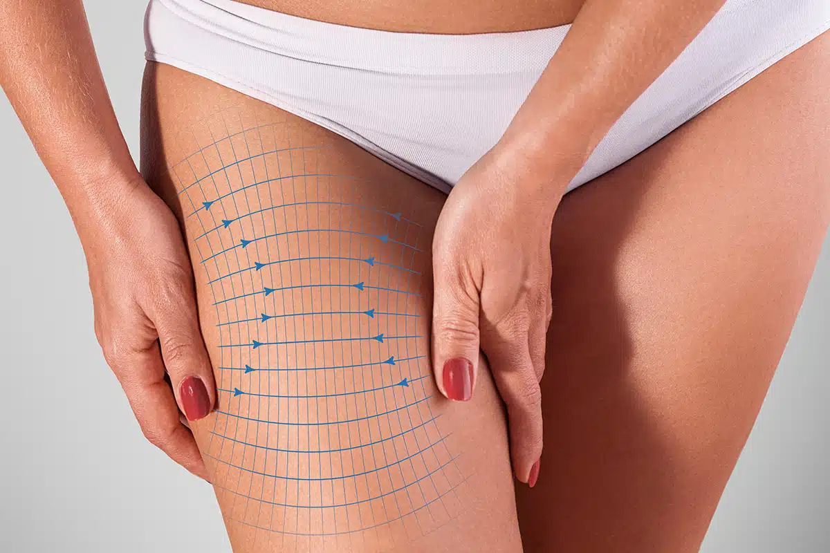 Thigh Lift Recovery Timeline: Week by Week (2025)