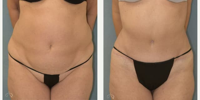 Mommy Makeover procedure image