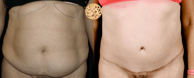 Skin Tightening procedure image