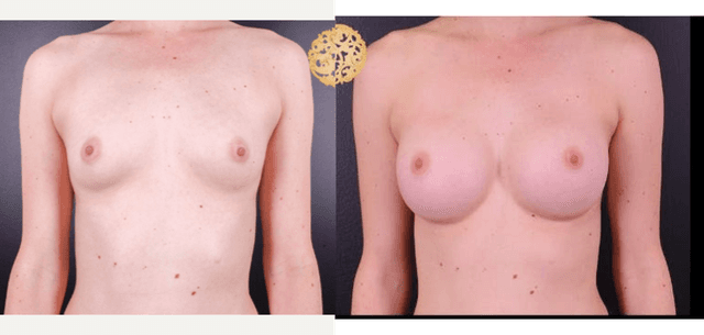 Breast Augmentation procedure image