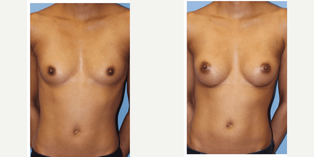 Mommy Makeover procedure image