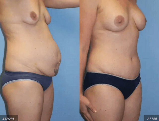 Skin Tightening procedure image