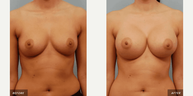 Breast Augmentation procedure image