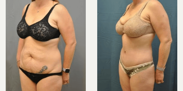 Tummy Tuck (Abdominoplasty) procedure image
