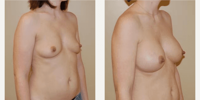 Breast Augmentation procedure image