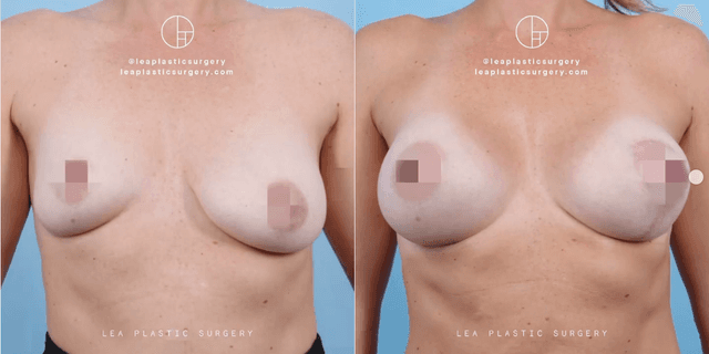 Breast Augmentation procedure image