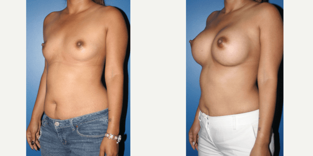 Tummy Tuck (Abdominoplasty) procedure image