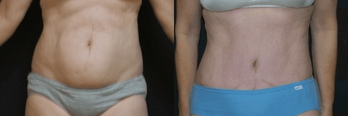 Skin Tightening procedure image