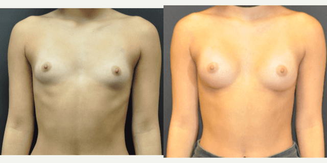 Mommy Makeover procedure image