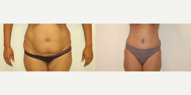 Mommy Makeover procedure image