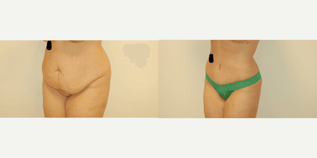 Skin Tightening procedure image