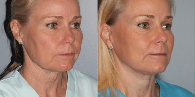 Facelift procedure image