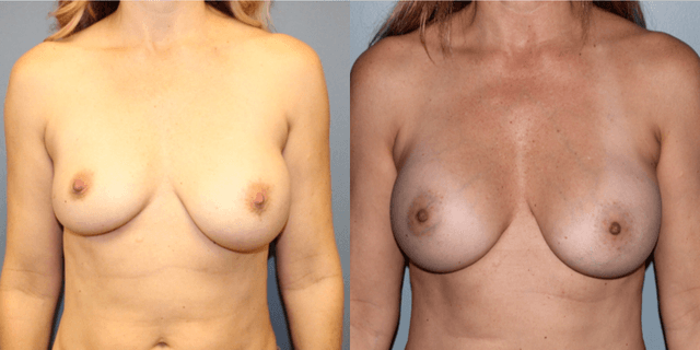 Breast Augmentation procedure image