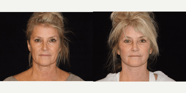 Facelift procedure image