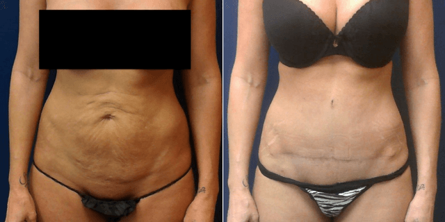 Breast Augmentation procedure image