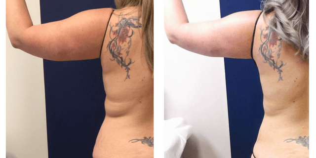 Body Lift procedure image