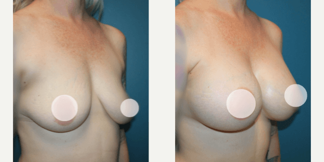 Breast Augmentation procedure image