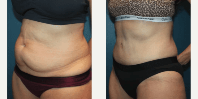 Skin Tightening procedure image