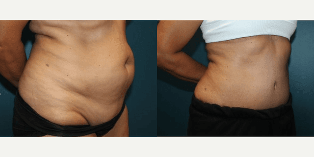 Mommy Makeover procedure image