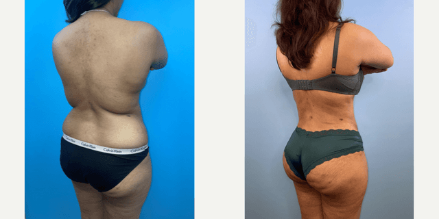 Mommy Makeover procedure image