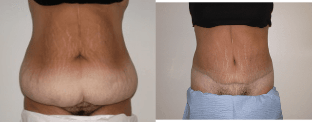 Skin Tightening procedure image