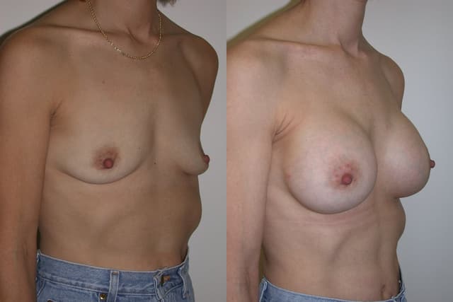 Breast Augmentation procedure image