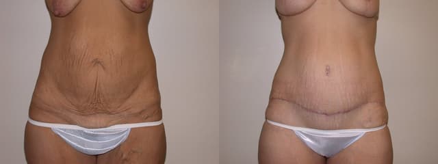 Mommy Makeover procedure image