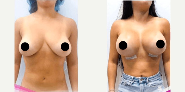 Breast Augmentation procedure image
