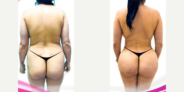 Hip Enhancement procedure image