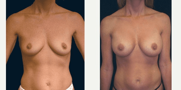 Breast Augmentation procedure image