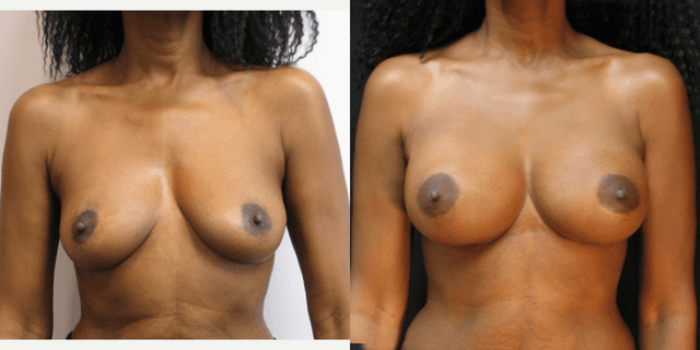 Mommy Makeover procedure image