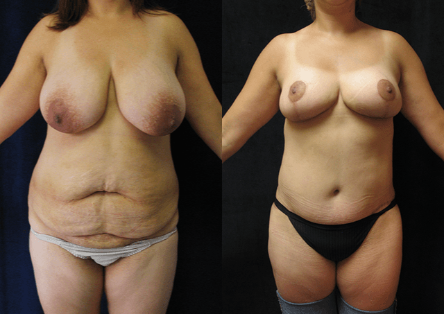 Tummy Tuck (Abdominoplasty) procedure image