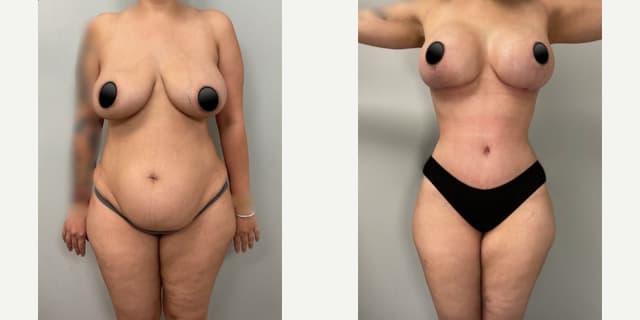 Breast Augmentation procedure image
