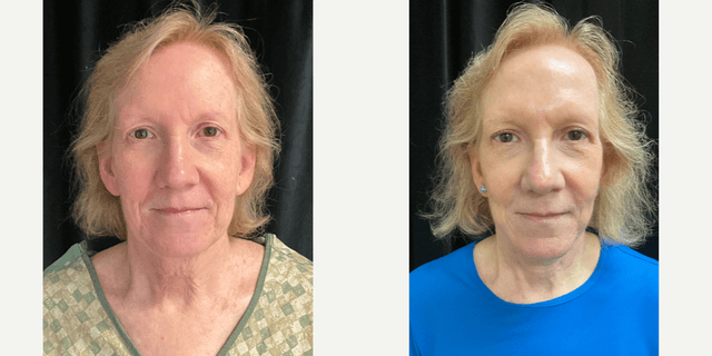 Facelift procedure image