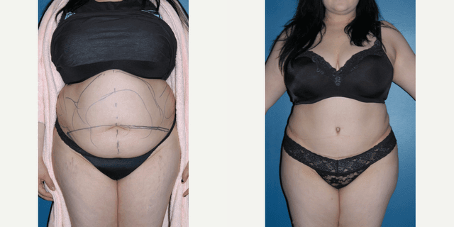 Tummy Tuck (Abdominoplasty) procedure image
