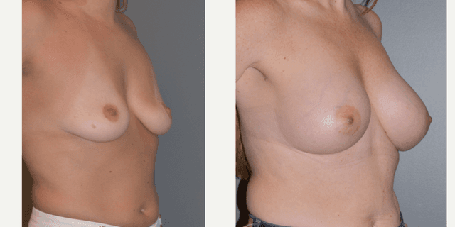 Breast Augmentation procedure image