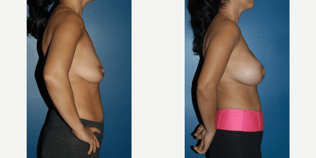 Mommy Makeover procedure image