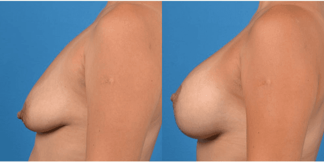 Mommy Makeover procedure image